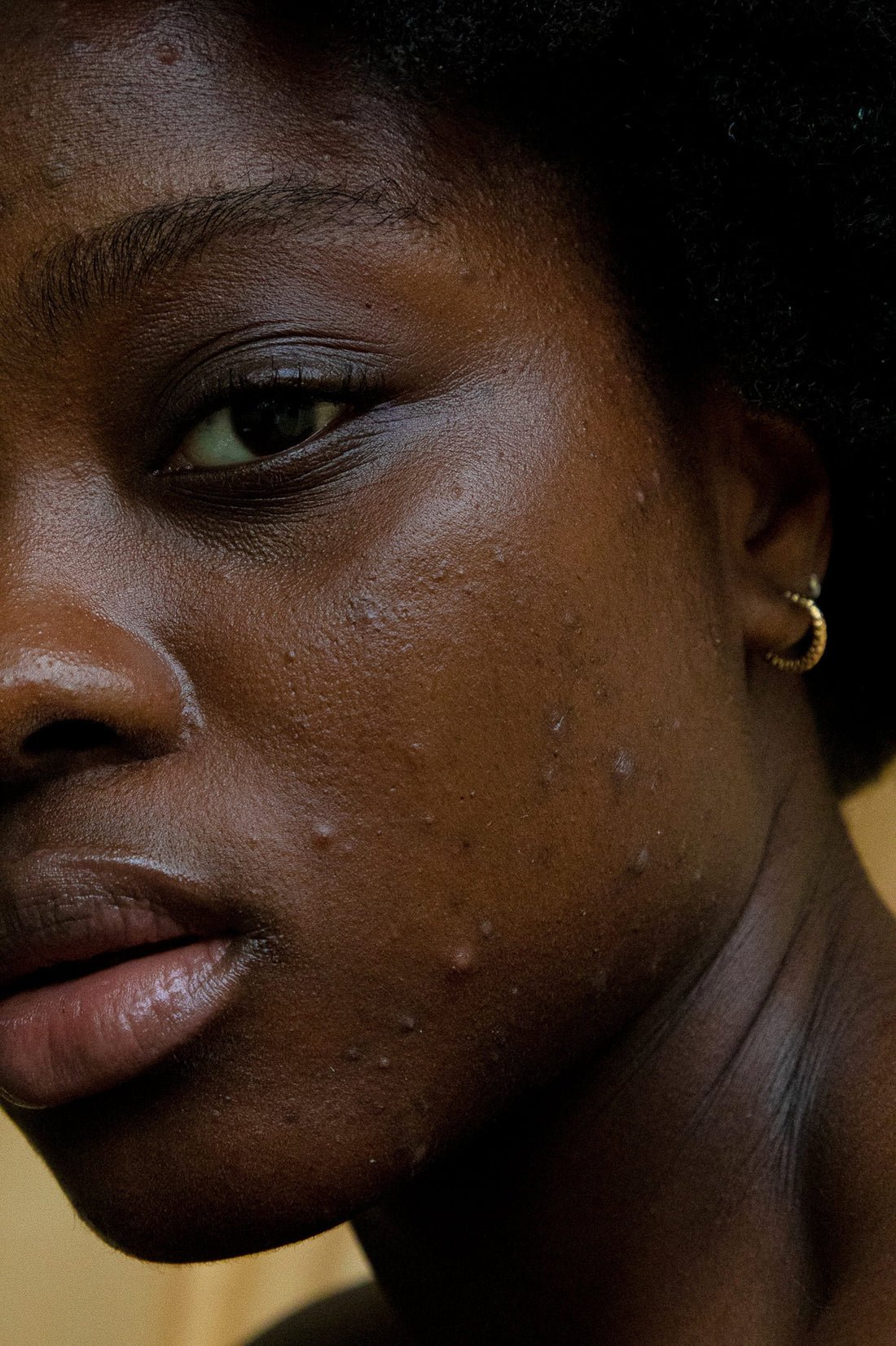 Hyperpigmentation : ce que personne ne vous dit